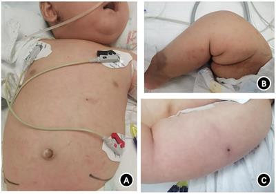 X-linked severe combined immunodeficiency complicated by disseminated bacillus Calmette-Guérin disease caused by a novel pathogenic mutation in exon 3 of the IL2RG gene: a case report and literature review